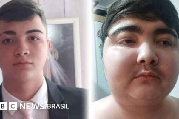 Tumor na base do crânio causa ganho de peso em Gustavo de Oliveira